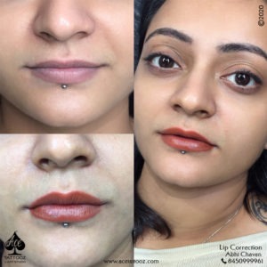 Lip Correction Treatment