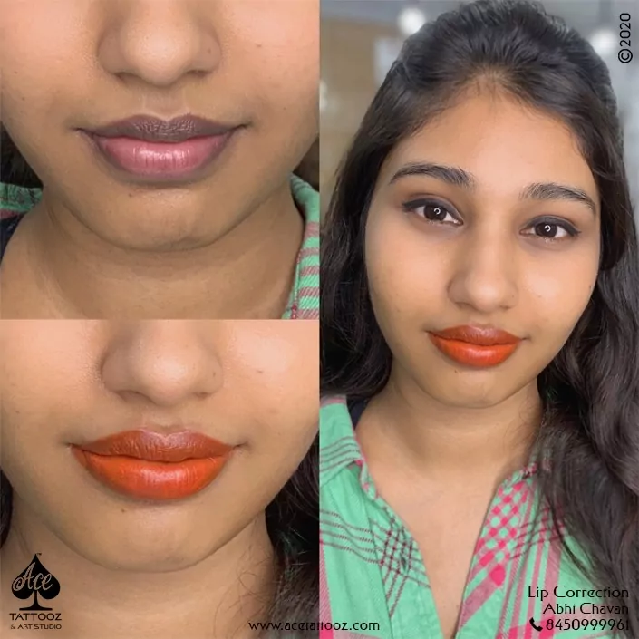 Best Lip Correction Treatment in Mumbai